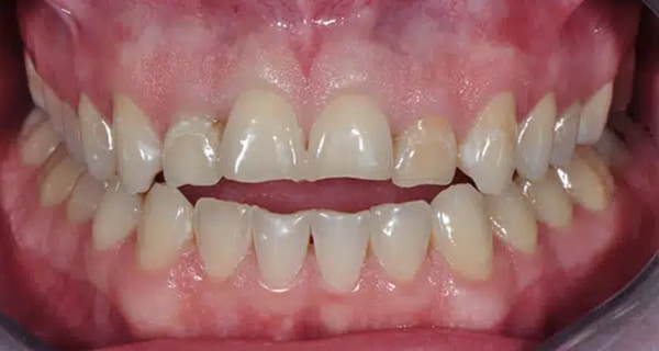 Before and After at Dakota Smiles!