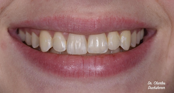 Before and After at Dakota Smiles!