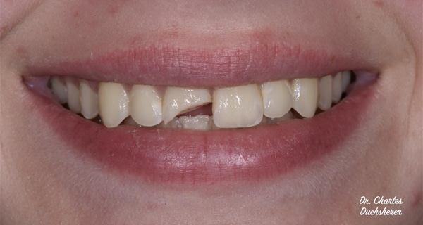 Before and After at Dakota Smiles!
