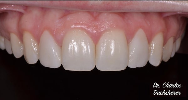 Before and After at Dakota Smiles!