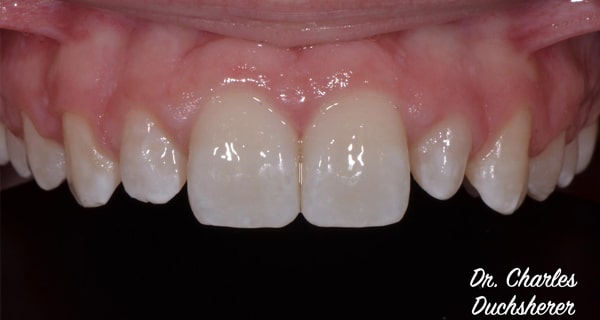 Before and After at Dakota Smiles!