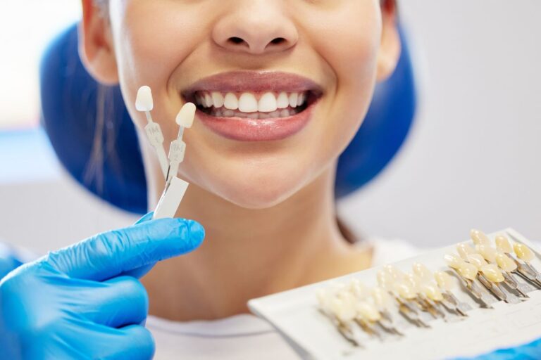 Veneers