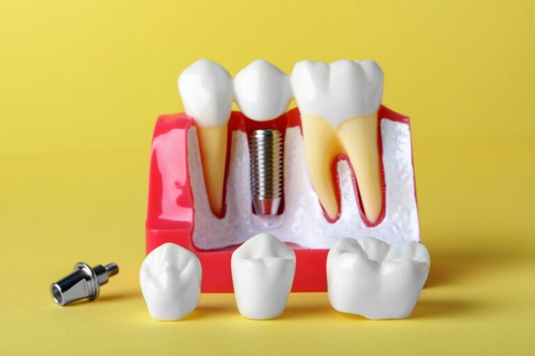 Dental Implants