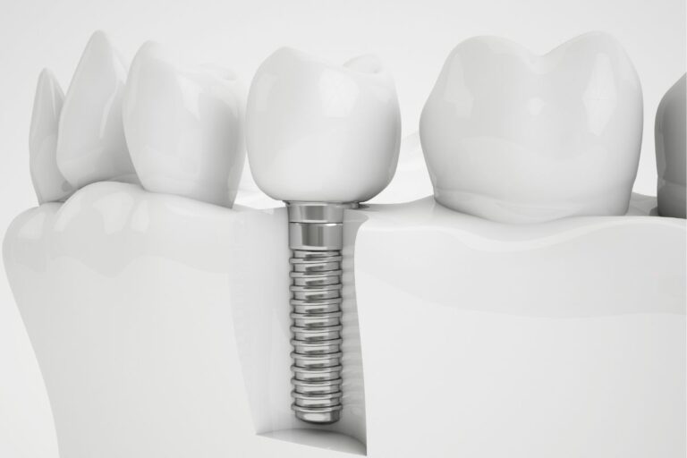 Dental Implants