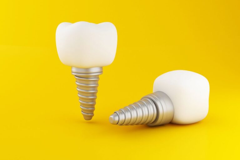 dental implants