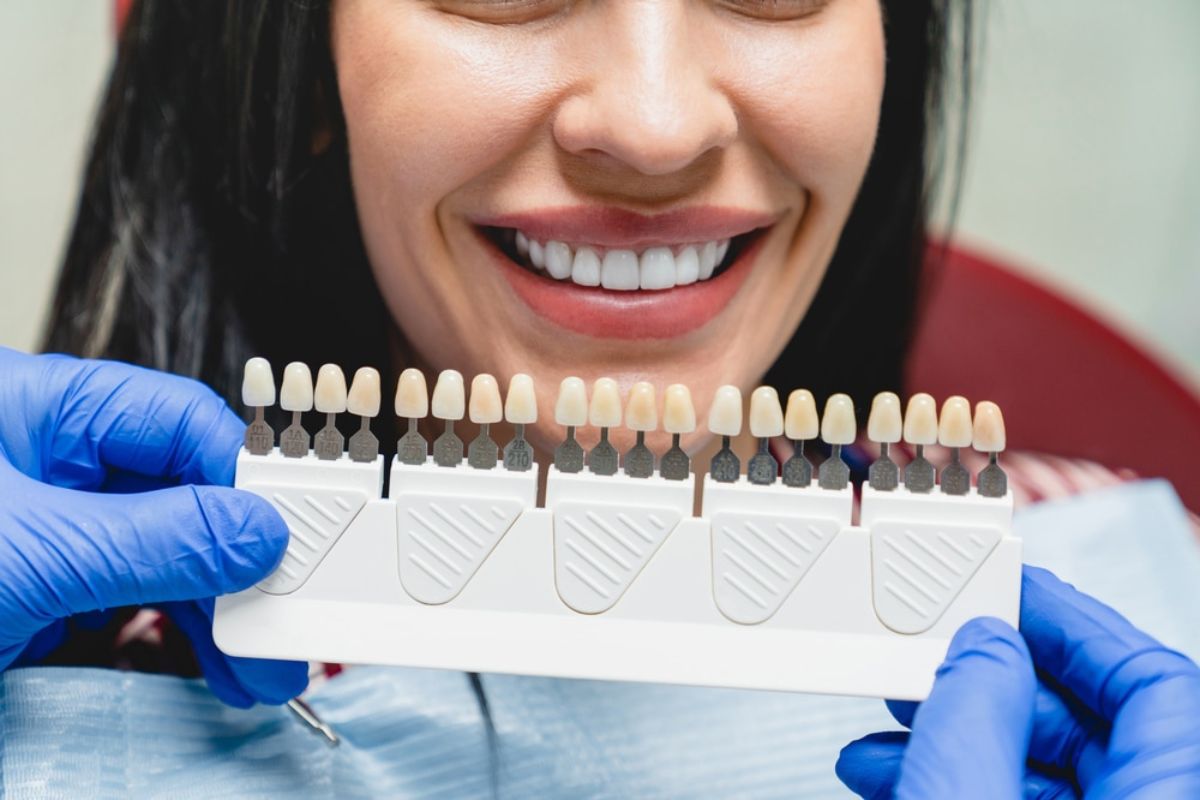 veneers