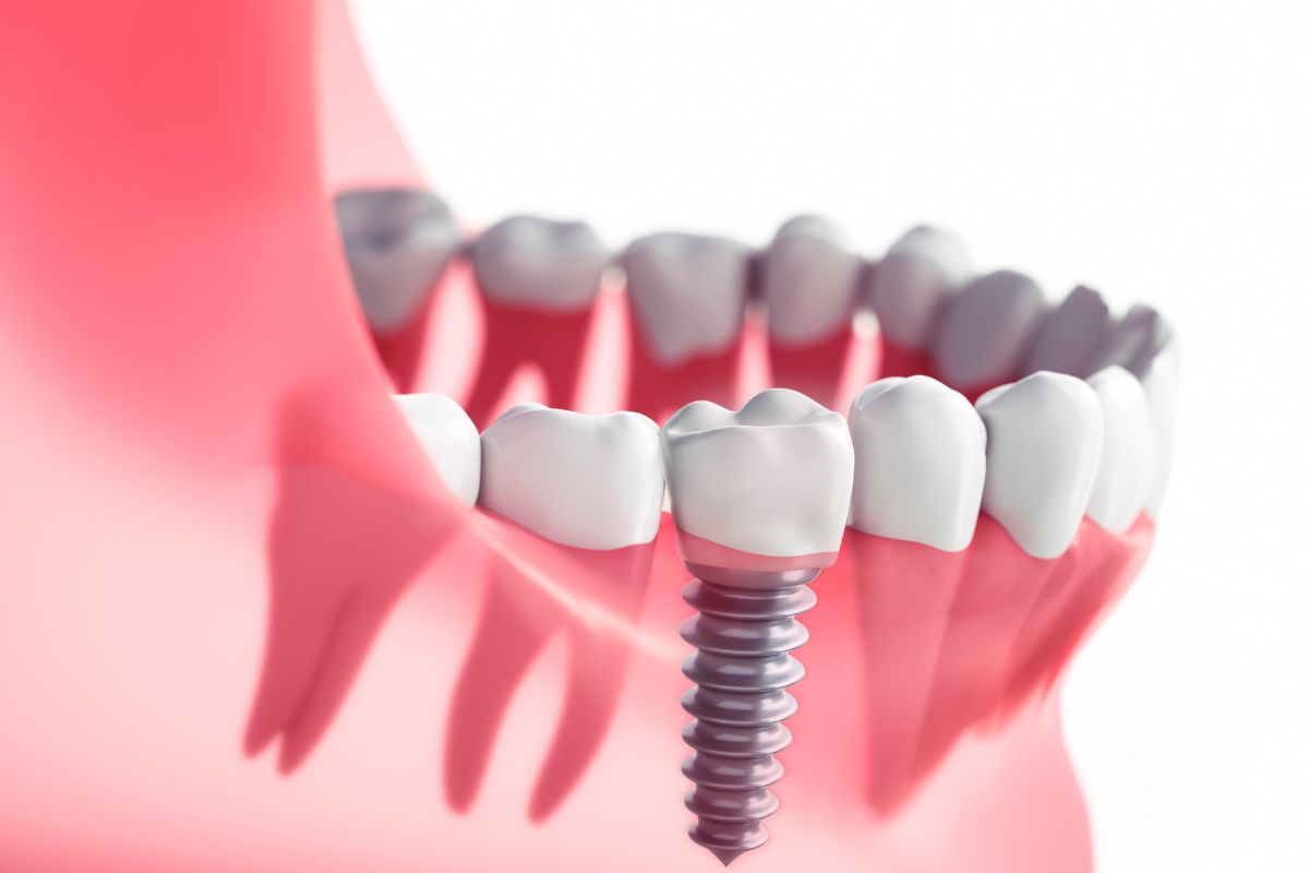 Will Dental Implants Affect My Facial Features