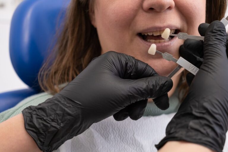 Veneers Fall Off Over Time