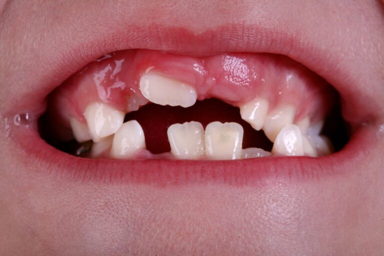 Child's open mouth showing baby teeth with some missing and adult teeth coming in.