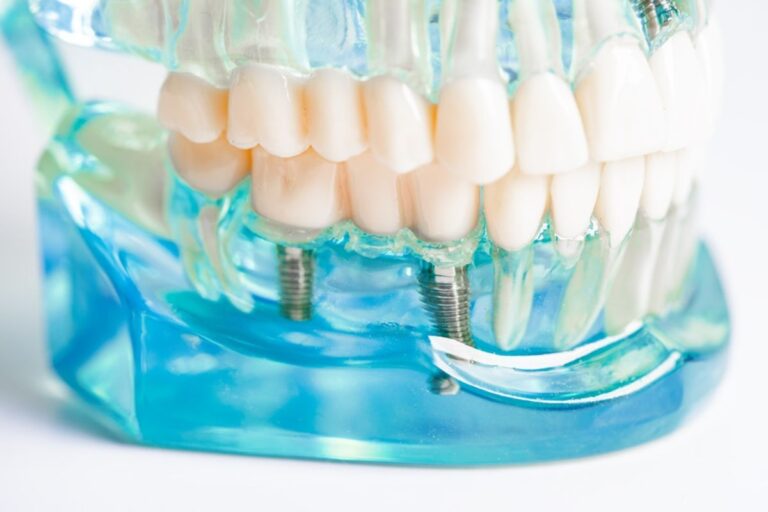 Prevent Infection After Dental Implants