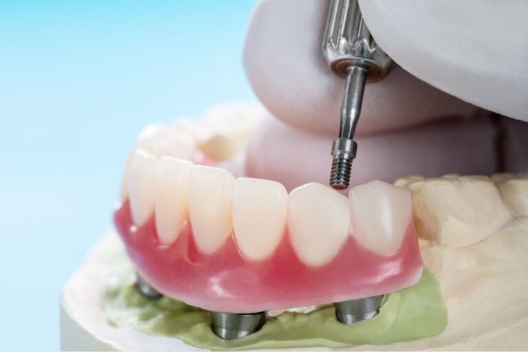 Advantages of All-on-Four Implants