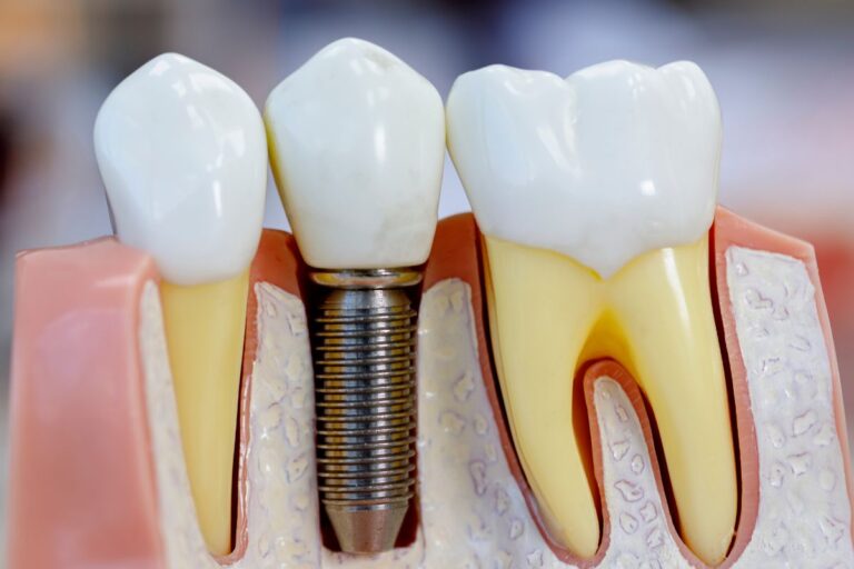 dental implants Fargo