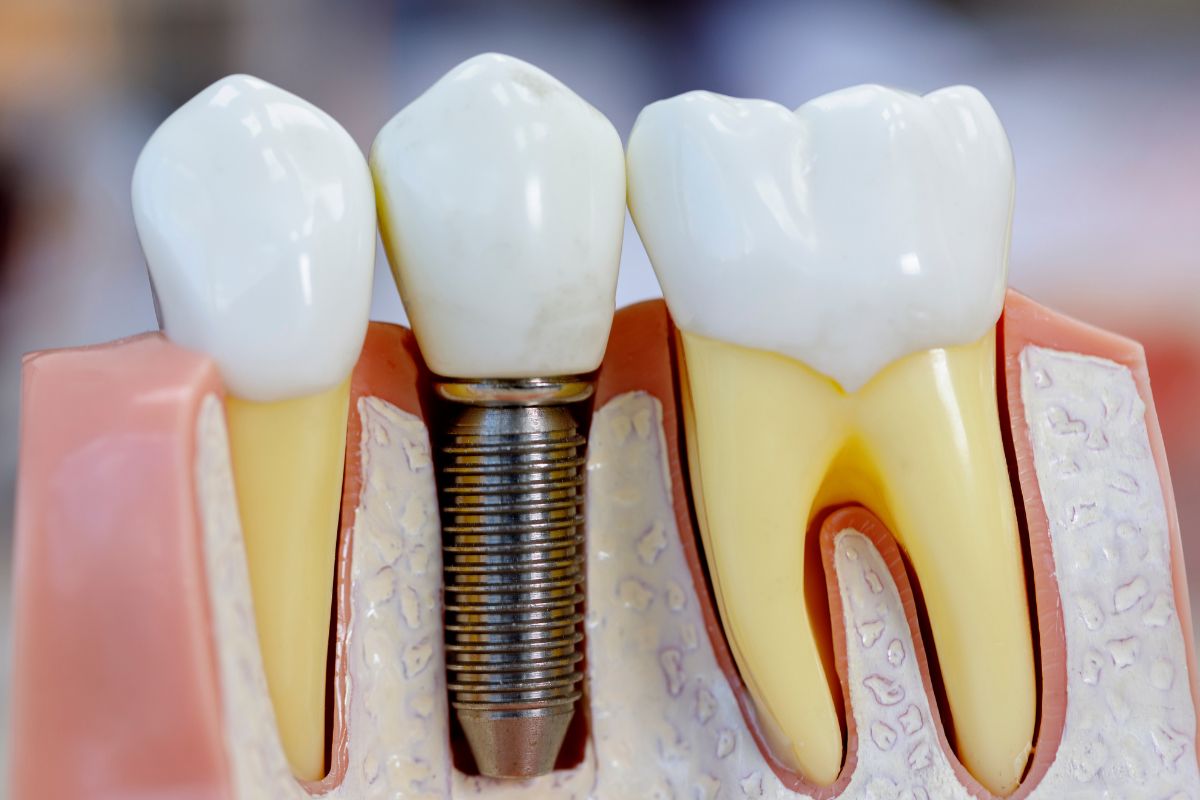 dental implants Fargo