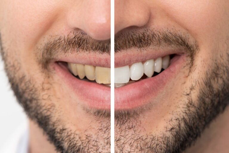 Can Cosmetic Dentistry Fix Discolored Teeth