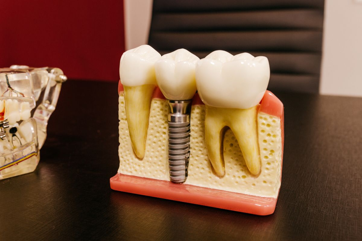 Dental Implants