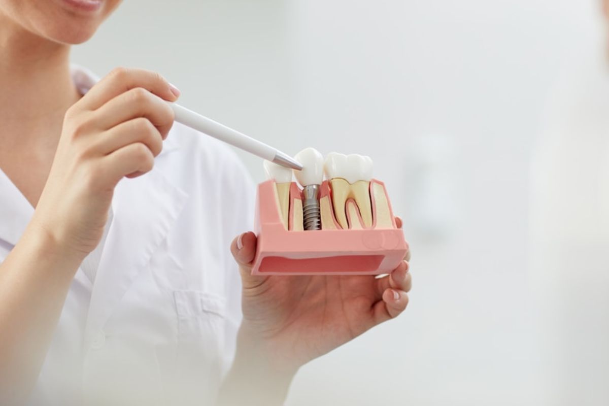 dental implants for front tooth