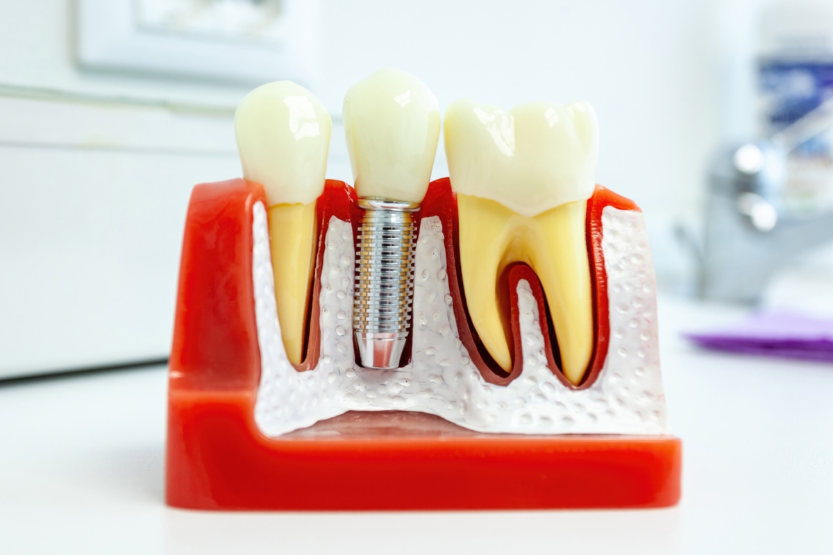 Can I Get Dental Implants If I Have Gum Disease