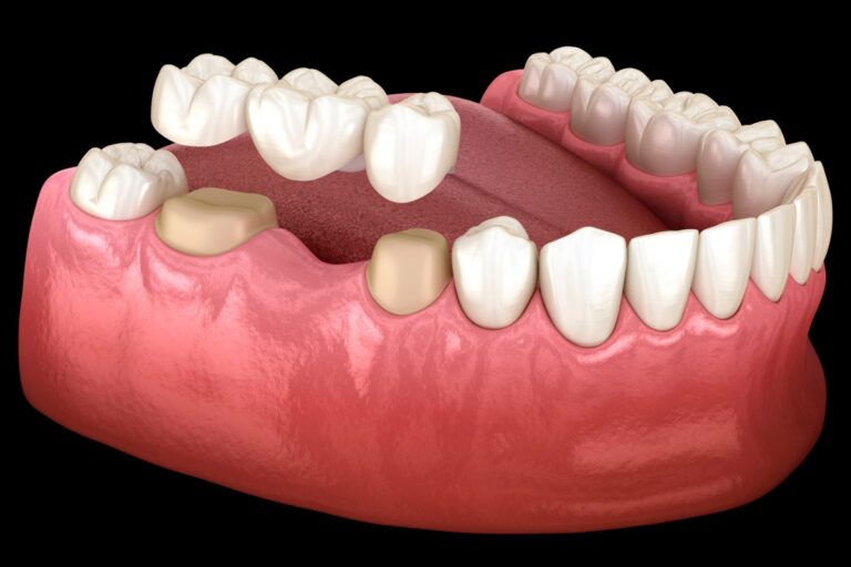 5 Immediate Actions to Take When a Dental Bridge Falls Out