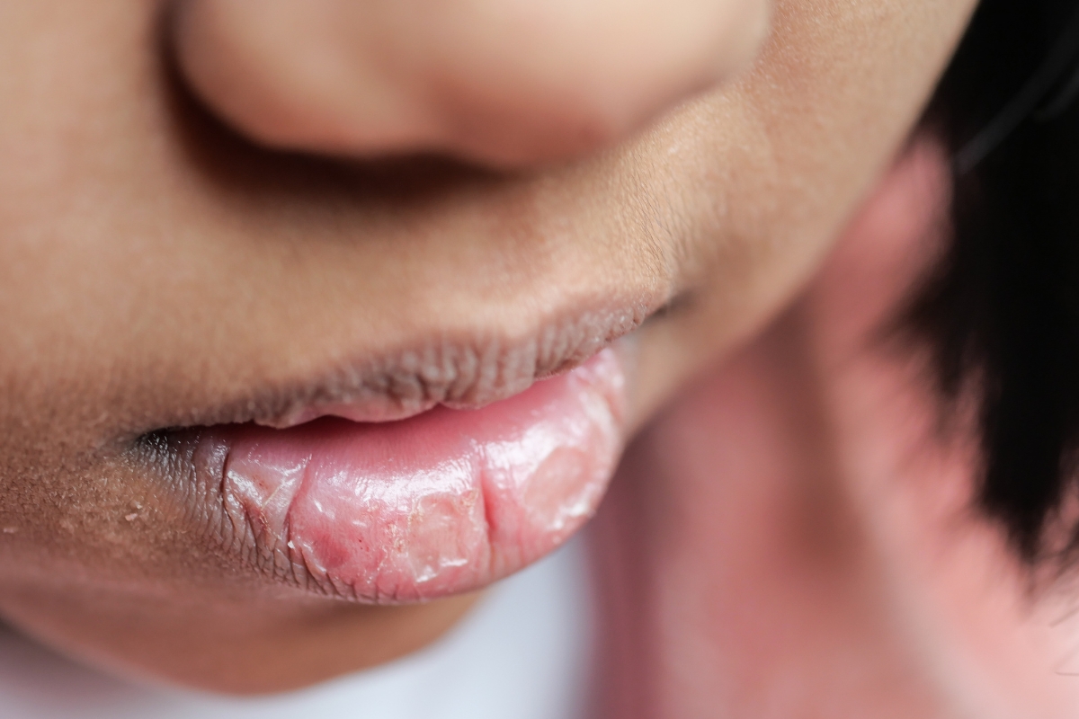 Dry Mouth Relief The Ultimate Food