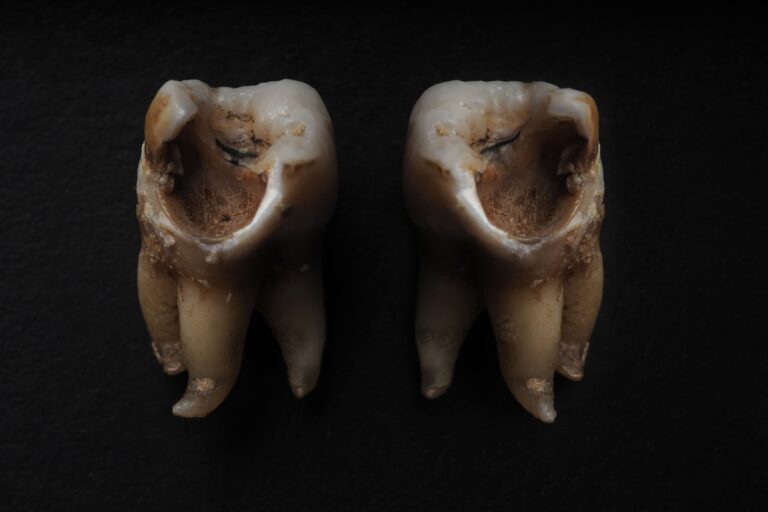 What Should You Do If a Decayed Tooth Falls Out