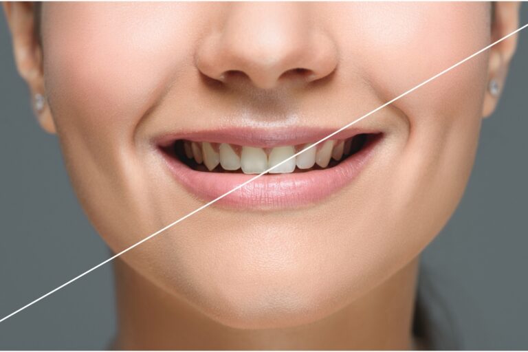 Homemade Teeth Whitening Solutions That Actually Work for Fargo People
