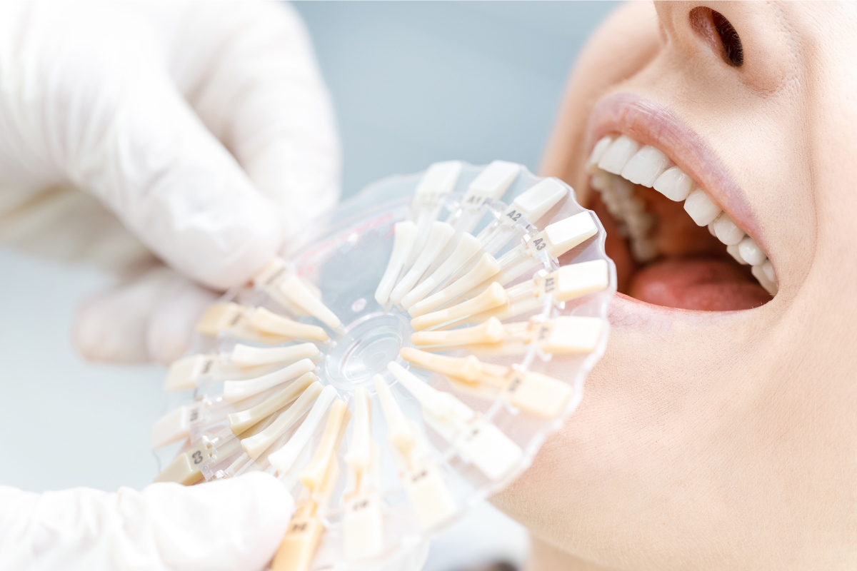 What Happens if a Dental Veneer Chips or Breaks