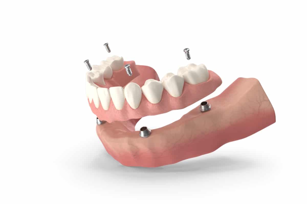 Five Factors To Consider Before Getting All-on-4® Dental Restoration