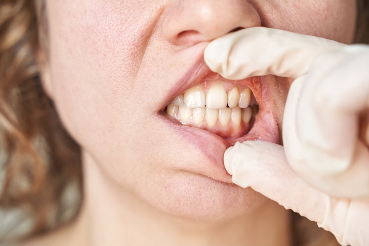 What Vitamin Deficiency Causes Enamel Erosion
