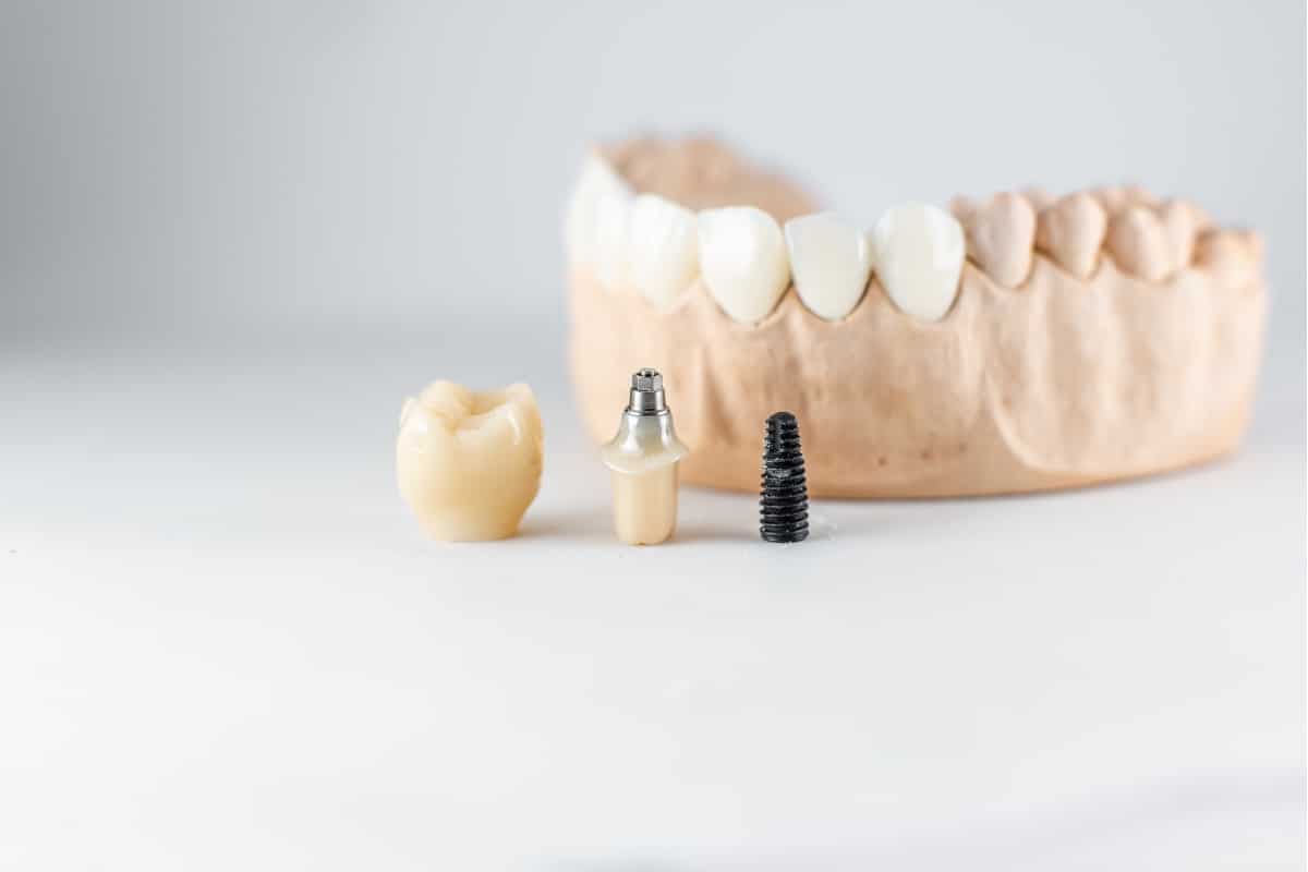 The Different Types of Dental Implant Screws: Which One Is Right for You