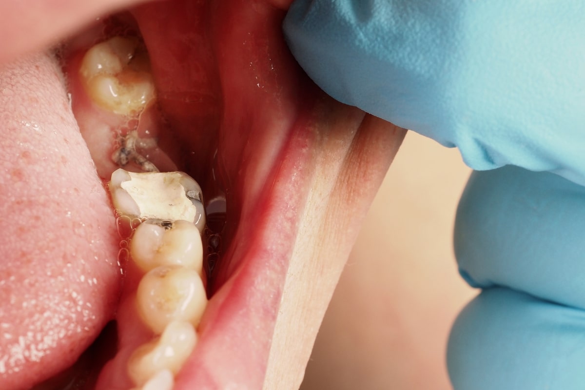 What Happens to the Stitches After a Tooth Extraction